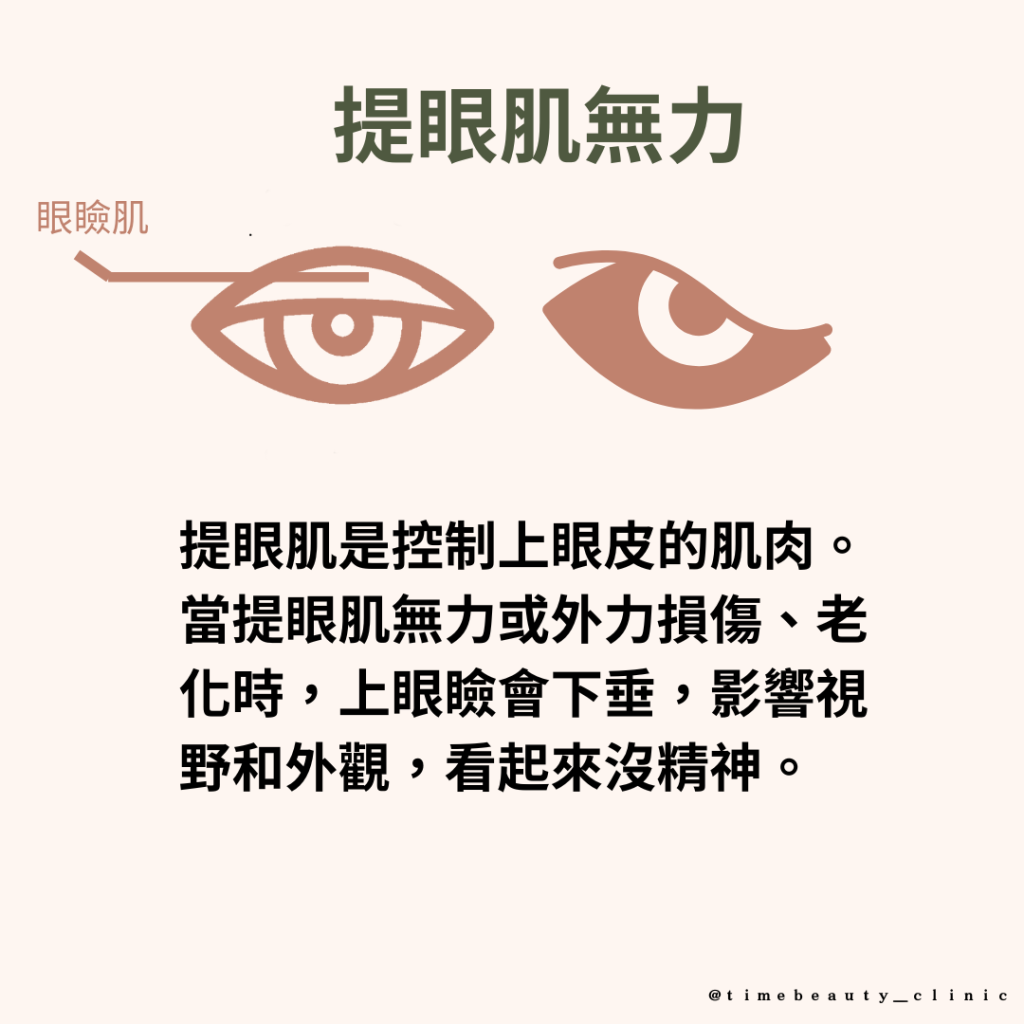 提眼肌無力，提眼瞼肌無力