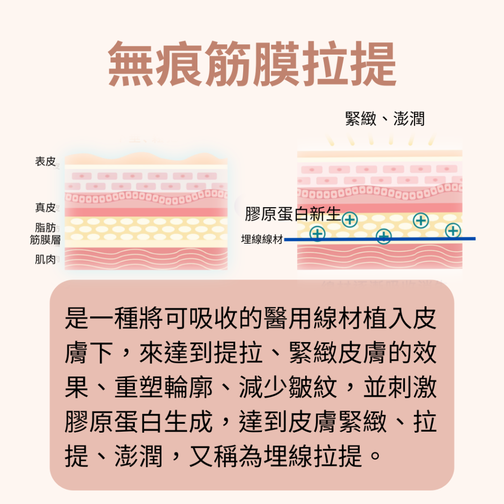 筋膜拉提、筋膜提升、埋線拉提、埋線、輪廓固定