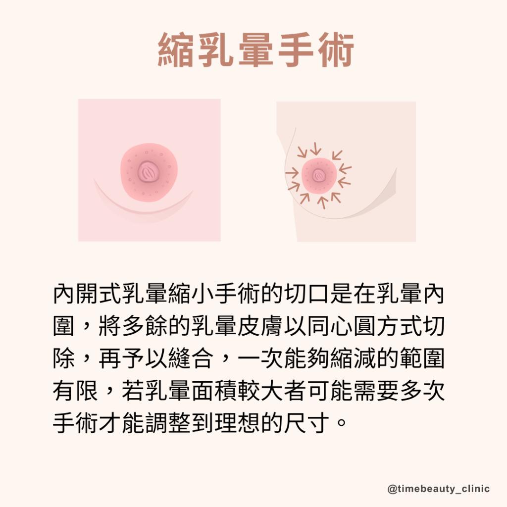 縮乳暈手術，內開縮乳暈，外開縮乳暈