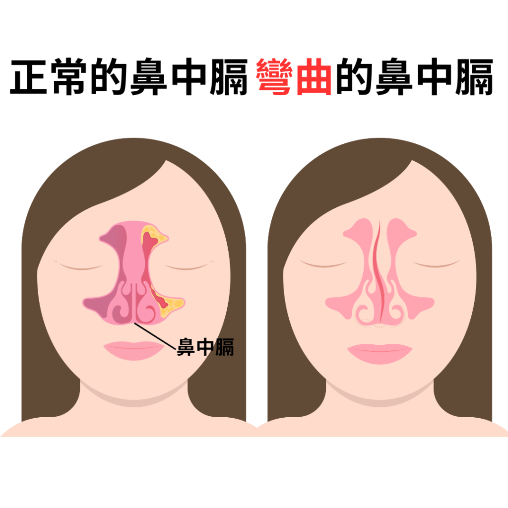 鼻中膈彎曲隆鼻，鼻中膈手術、鼻中膈手術費用