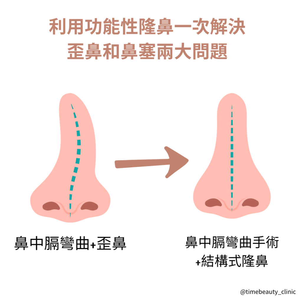 功能性隆鼻